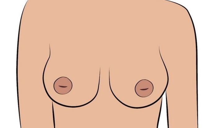 Vpáčené bradavky – tyto bradavky jsou obrácené dovnitř do prsu. Ženy s tímto typem bradavek mívají obtíže při kojení a je potřeba se s nimi naučit pracovat.