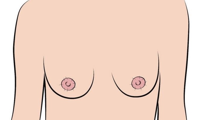 Chlupaté bradavky – sice nejspíš žádná žena nemá svůj hrudník jako její manžel, ale může se i stát, že se v okolí bradavek objeví dlouhé černé chloupky jako mají právě muži.