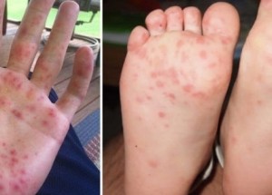 Nejnakažlivější nemoc na světě, která postihuje zejména malé děti - Slintavka a kulhavka