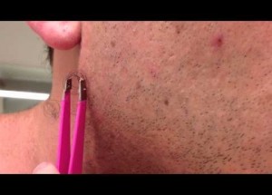 Tento muž měl několik let problém s vrostlým vlasem ve tváři. Video, kde ho vyndavá, položí každého!