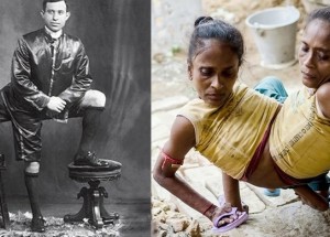 Lidé, kteří se narodili s částmi těla navíc. Objevovali se v minulosti a bohužel i dnes