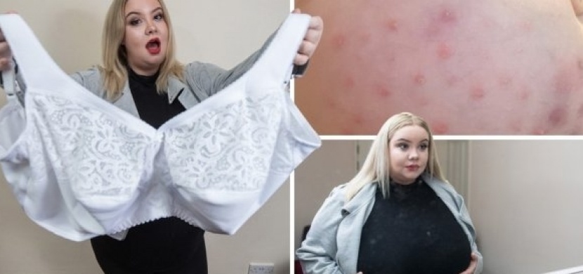 Tato žena trpí makromastií, v důsledku které jí neustále rostou prsa. „Je to jako prokletí,“ říká